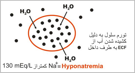 کمبود سدیم (هایپوناترمی) 1